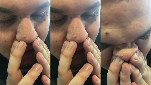 Centimeter Terugroepen Allerlei soorten Man laat zien hoe je in één keer alle mee-eters op je neus kunt  verwijderen... | DailyBuzz